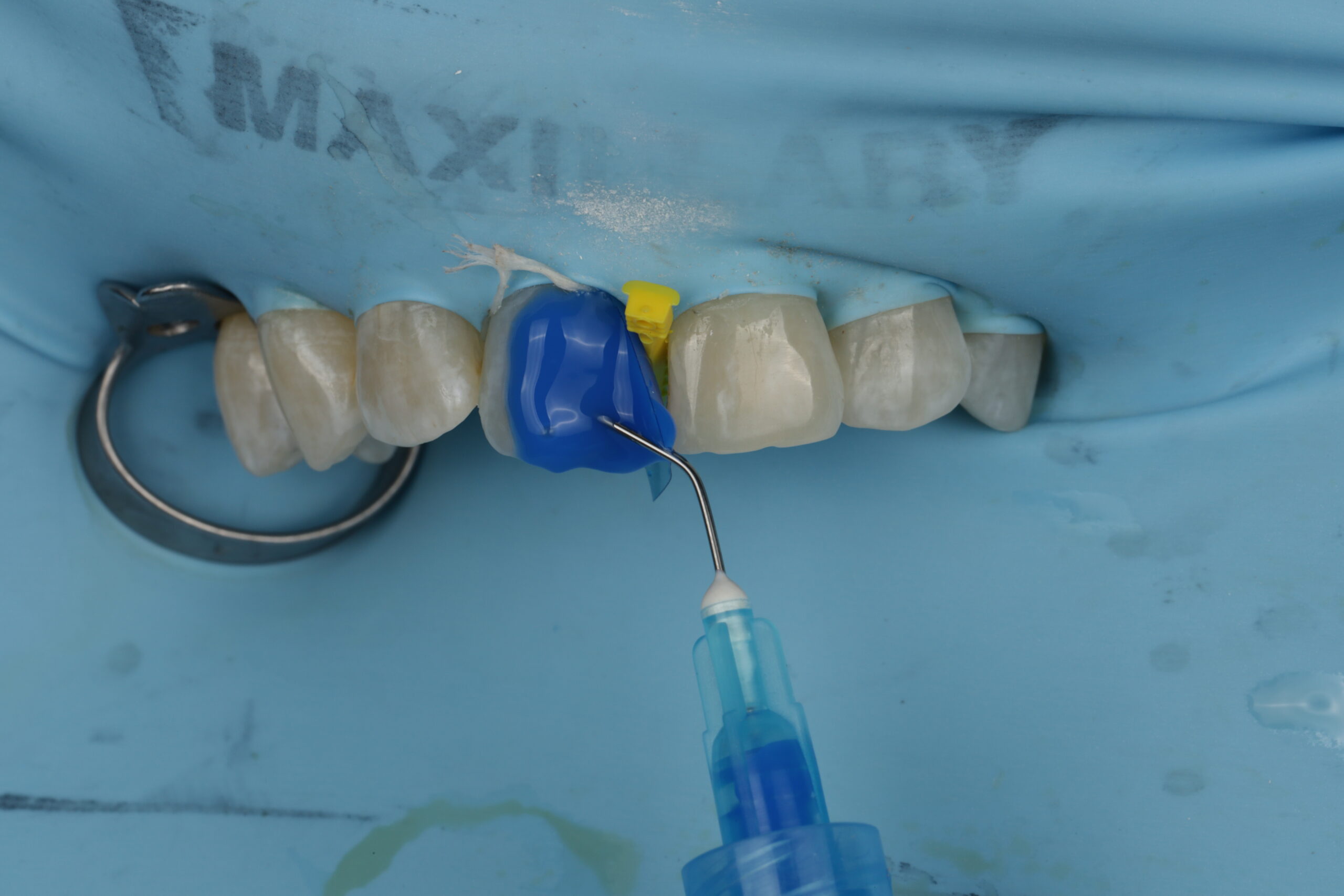 A dental isolation dam is applied to upper teeth, with a blue matrix band and dental tool positioned for a restorative procedure.