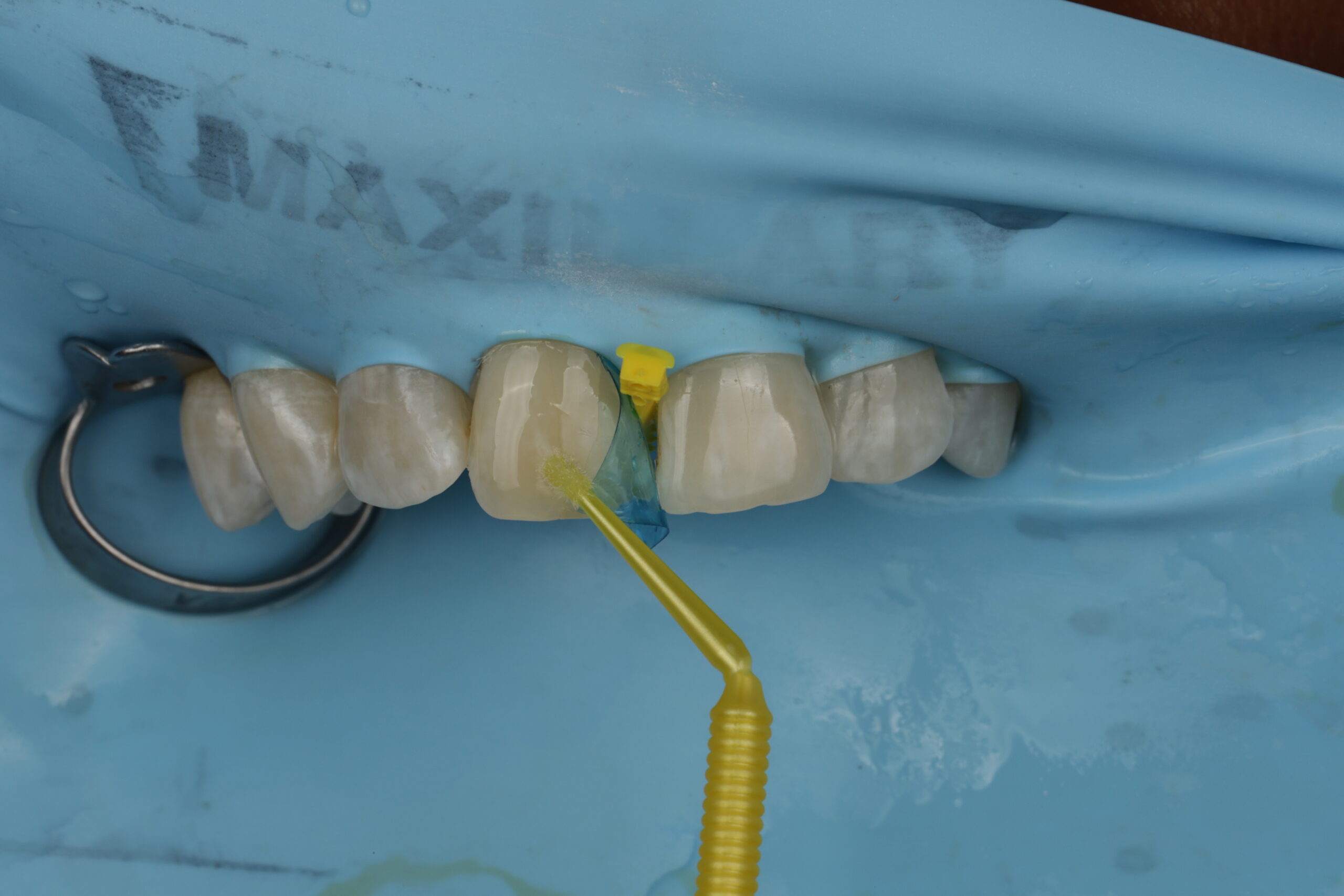 Close-up of dental procedure showing teeth isolated with a rubber dam and a dentist applying material to the front teeth using a yellow applicator brush.