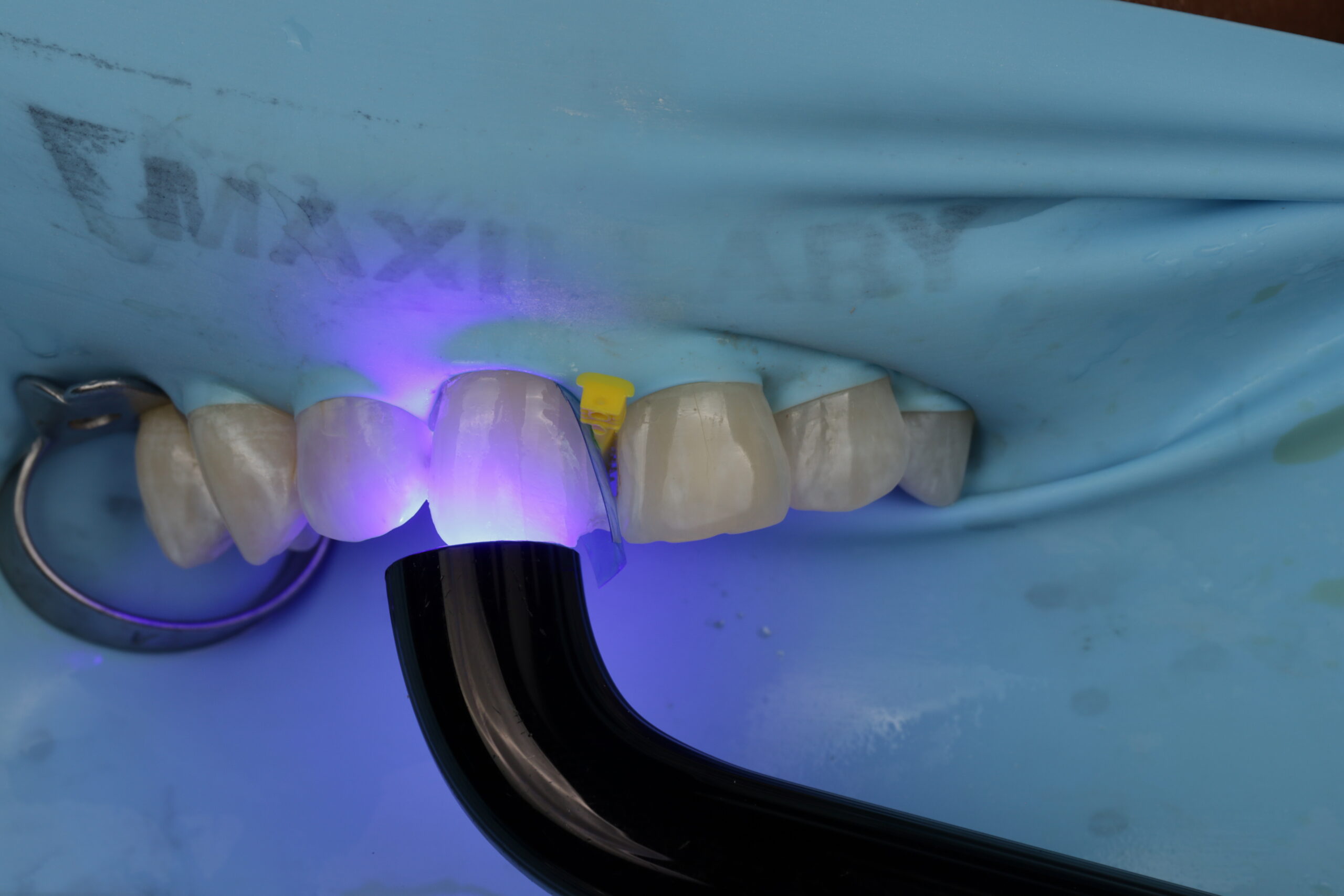 Close-up of dental curing light hardening a composite resin on a teeth with a rubber dam and metal clamp