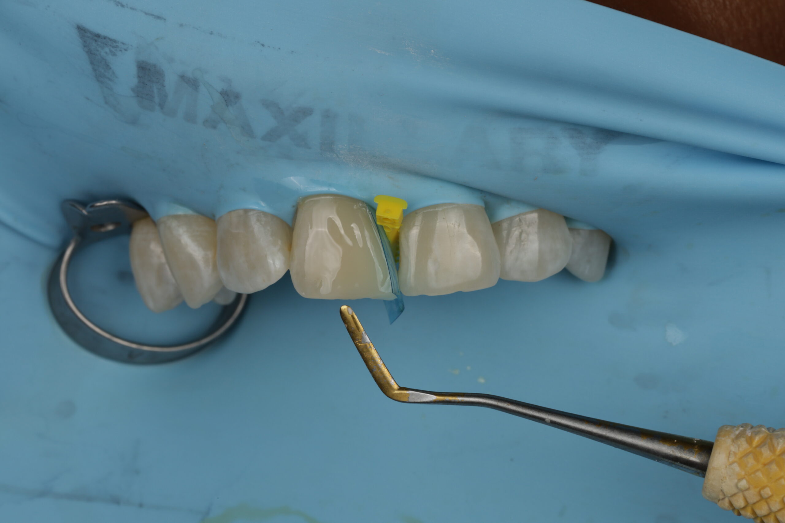 Close-up of teeth with a blue dental dam and a dental instrument holding a small yellow wedge between two teeth