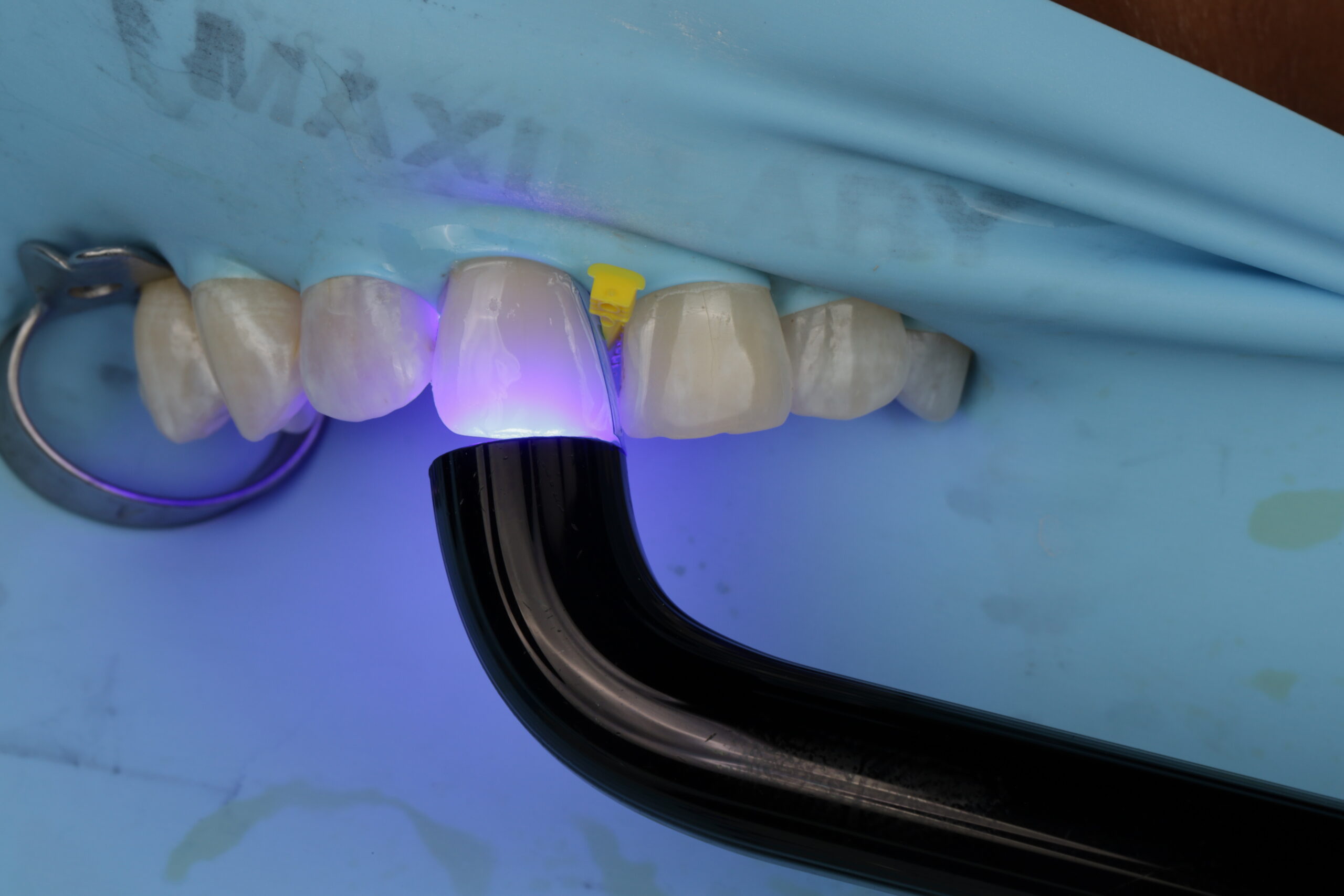 Dental curing light positioned on a teeth with a blue background and a yellow dental wedge between teeth