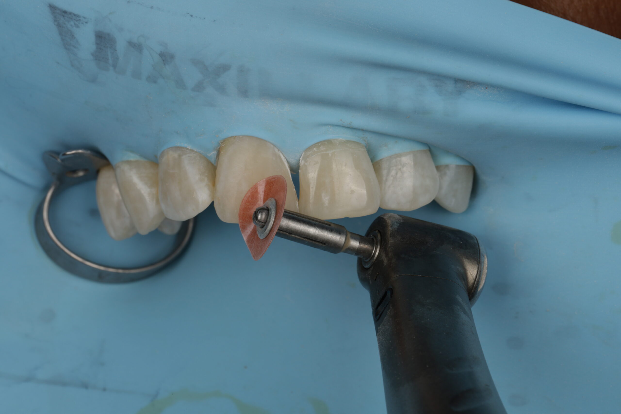 Dental polishing tool with a small disc polishing a set of upper front teeth isolated by a dental dam