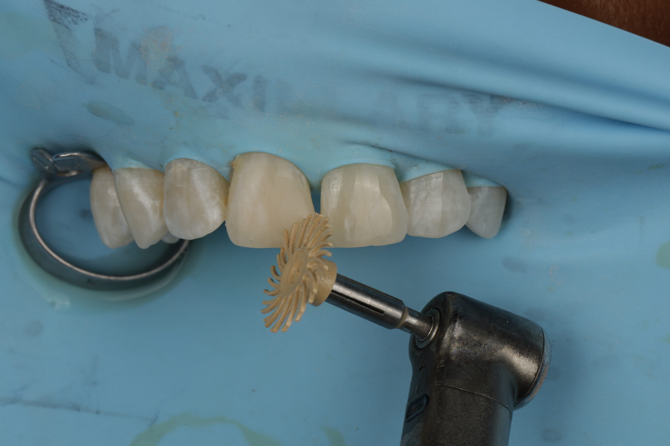 Close-up of dental restoration work on upper front teeth with a rotary polishing brush attached to a dental handpiece