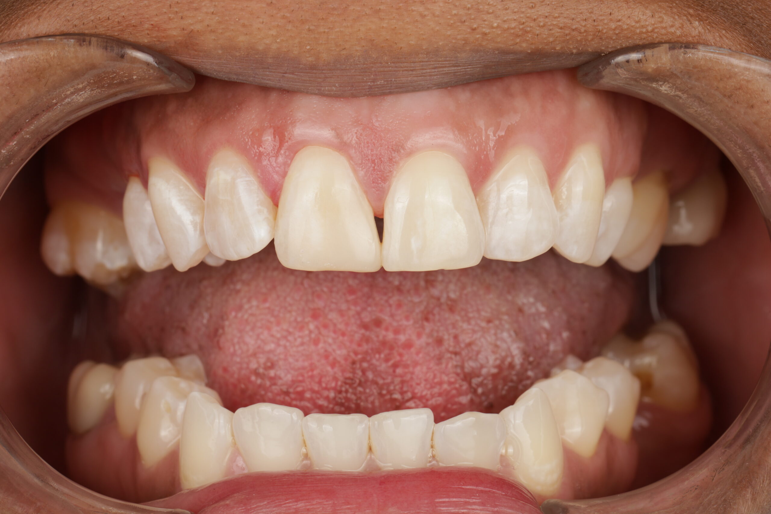 Close-up of open mouth showing upper and lower teeth with visible gums and tongue