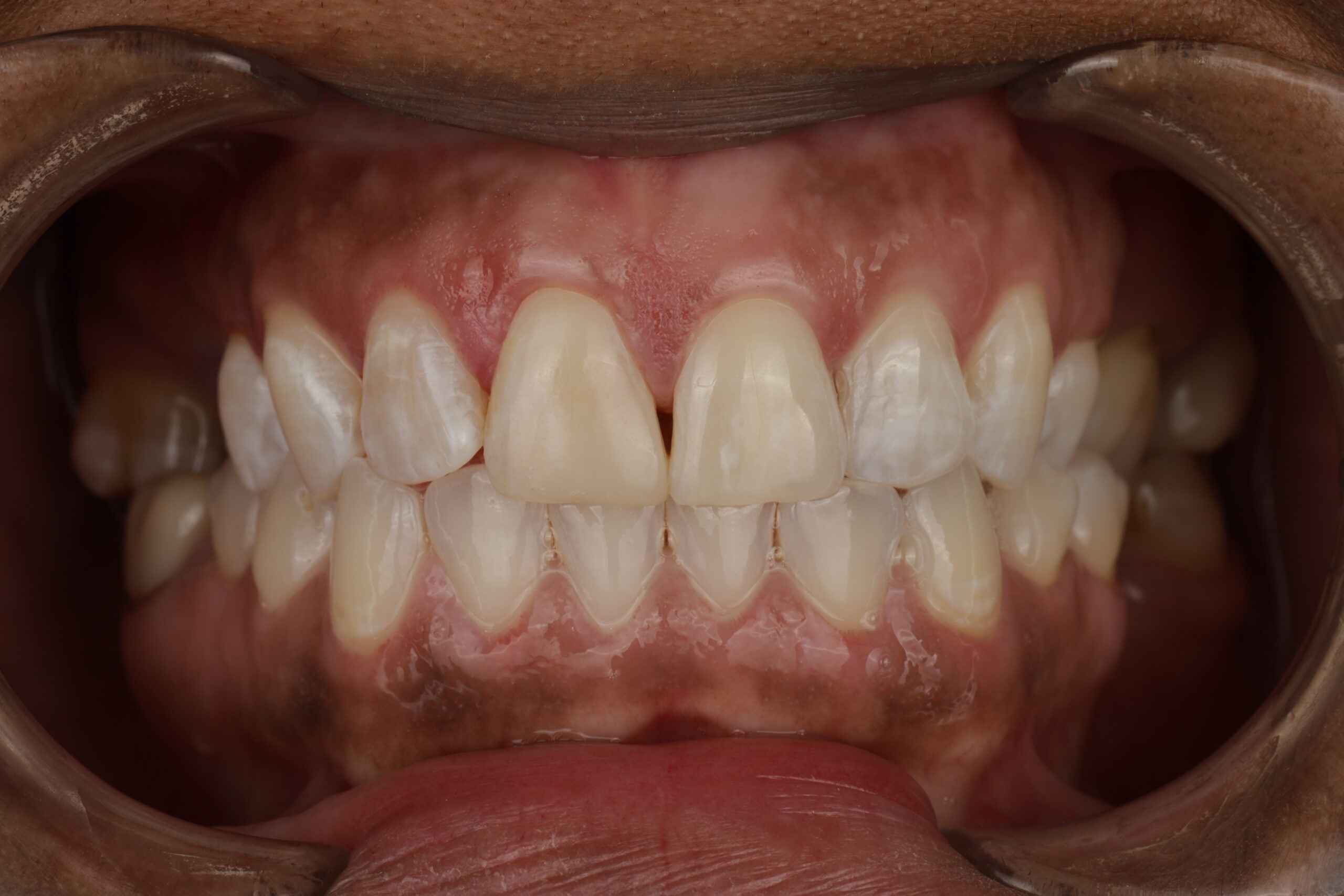 Close-up of upper and lower front teeth with two central upper teeth appearing larger and lighter than adjacent teeth