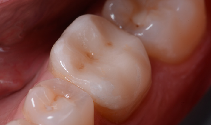 Close-up of three molar teeth with visible grooves and pits on the chewing surfaces