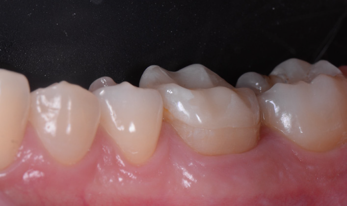 Close-up of lower molars and premolars with visible dental restorations on some teeth
