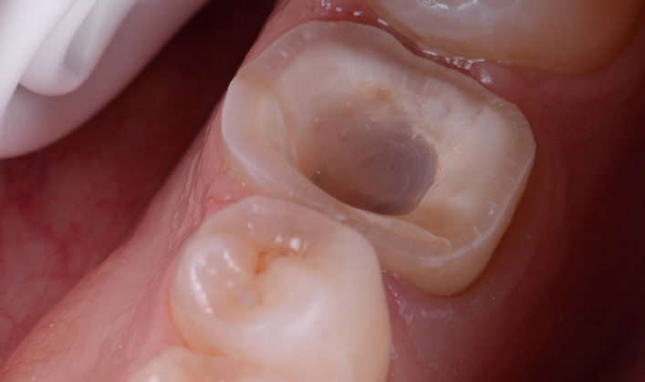 Close-up of a molar tooth with a large cavity preparation and adjacent teeth