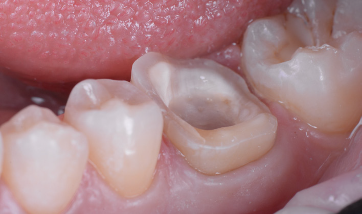 Close-up of lower molars with one tooth prepared for a dental crown
