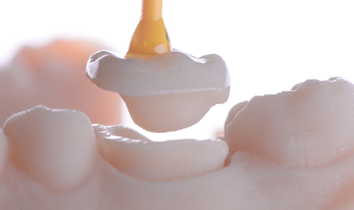 Dental crown being placed on a model of teeth