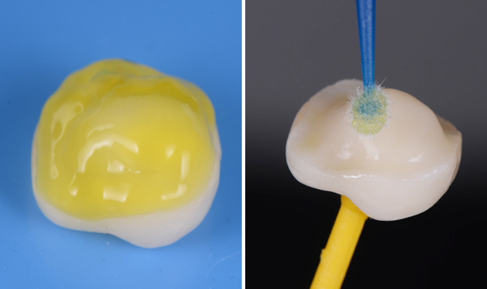 Two close-ups of a dental crown on a blue background on the left and a dental crown being brushed with a blue toothbrush on the right
