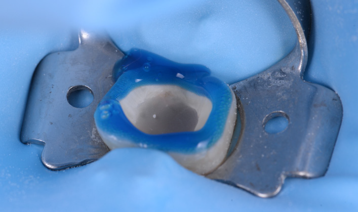 Tooth isolated with a dental rubber dam and metal clamp showing a cavity filled with blue dental material