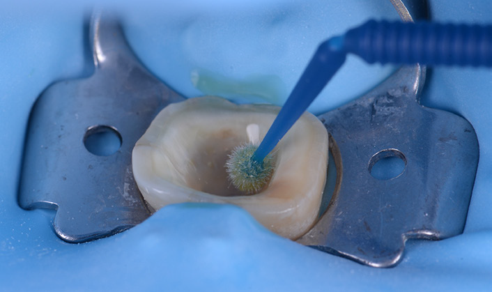 Close-up of a tooth isolated with a dental dam and clamp with a small brush applicator inside the tooth cavity