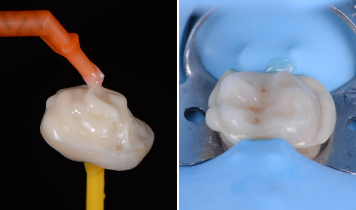 Two close-up views of a dental crown on a yellow holder with a dental applicator applying material on the left and the crown secured with a blue dental dam on the right
