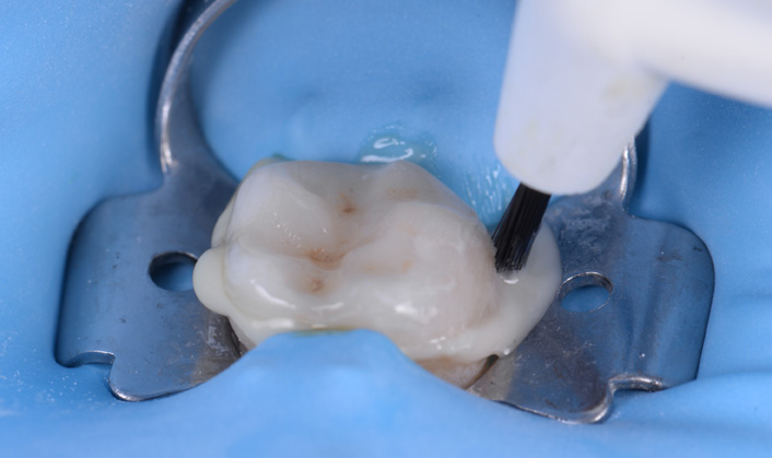 Close-up of a dental dam isolating a molar tooth with a dental instrument applying liquid on the tooth surface