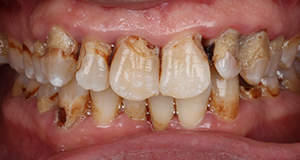 Close-up of a mouth showing severely decayed and discolored teeth