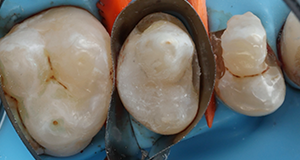 Close-up of three molar teeth with a dental clamp and rubber dam in place