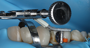 Dental impression tray with attached metal handle and dental model on blue background