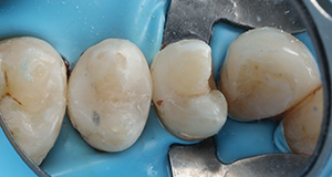 Close-up of four molar teeth with a dental clamp and blue rubber dam around them