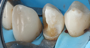 Close-up of three dental crowns fitted on a blue dental model with a metal clamp