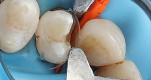 Close-up of dental tools working on a molar tooth with a blue dental dam in place
