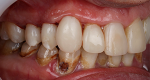 Close-up of lower and upper teeth showing severe dental decay and missing teeth