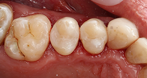 Close-up of lower molars and premolars showing dental anatomy and occlusal surfaces