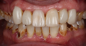 Close-up of upper and lower teeth showing significant plaque and tartar buildup