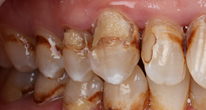 Close-up of teeth with severe decay and discoloration