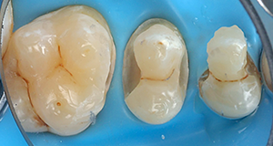 Close-up of three molar teeth with dental dam and metal clamp
