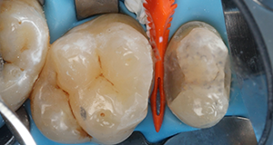 Close-up of molar teeth with dental dam and orange dental instrument inserted between two teeth