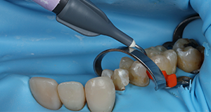 Dental procedure showing a dental tool applying material to a tooth with a dental dam in place