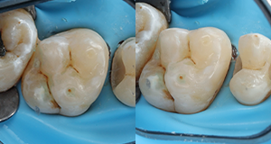 Close-up of three molar teeth with dental fillings and a metal dental clamp