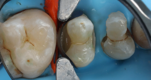 Close-up of three molar teeth isolated with a dental rubber dam and metal clamp