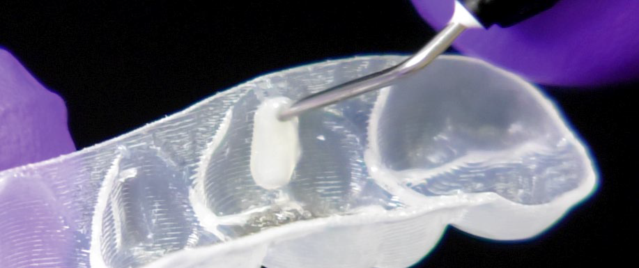 A dental tool applies a material onto a transparent dental tray, held by a person wearing purple gloves, against a black background.