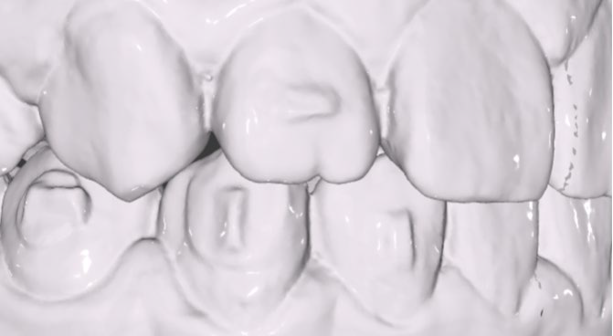 3D dental scan showing upper and lower teeth with noticeable misalignment and crowding.