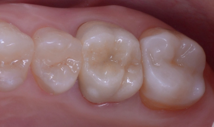 Close-up of four lower molars with one molar restored by a glass ceramic overlay