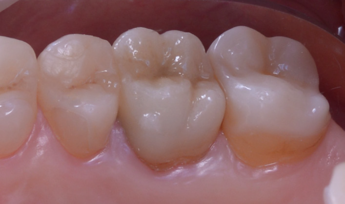 Close-up of four lower molars with a glass ceramic overlay on the second molar from the right