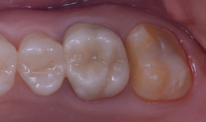 Close-up of four upper molars showing a glass ceramic overlay on the second molar from the right
