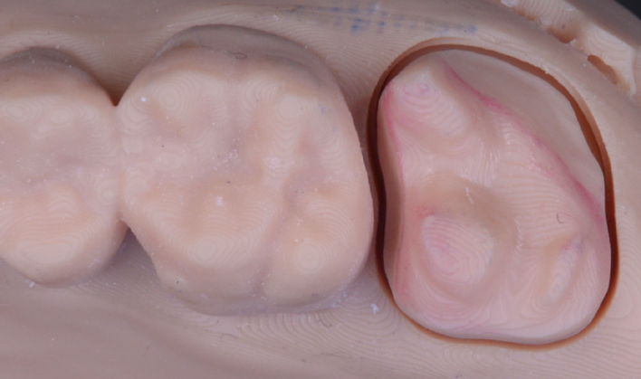 Close-up of a dental model showing a prepared tooth next to two adjacent teeth