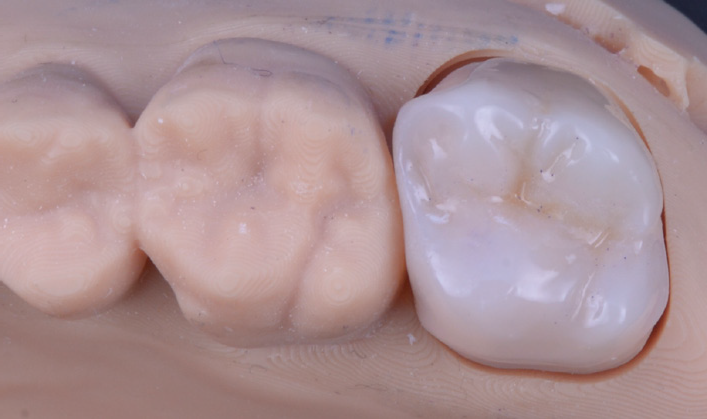Close-up of a dental model showing a glass ceramic overlay on a molar next to natural teeth