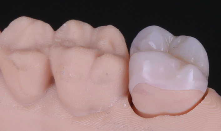 Dental model showing a glass ceramic overlay bonded to a molar tooth