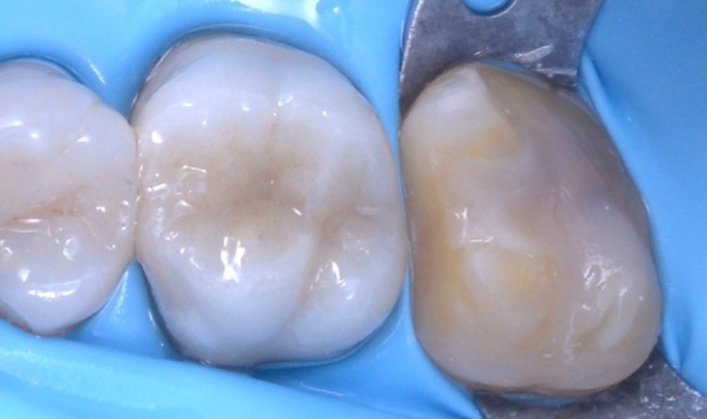 Close-up of three molar teeth with a dental rubber dam and metal clamp on the rightmost tooth