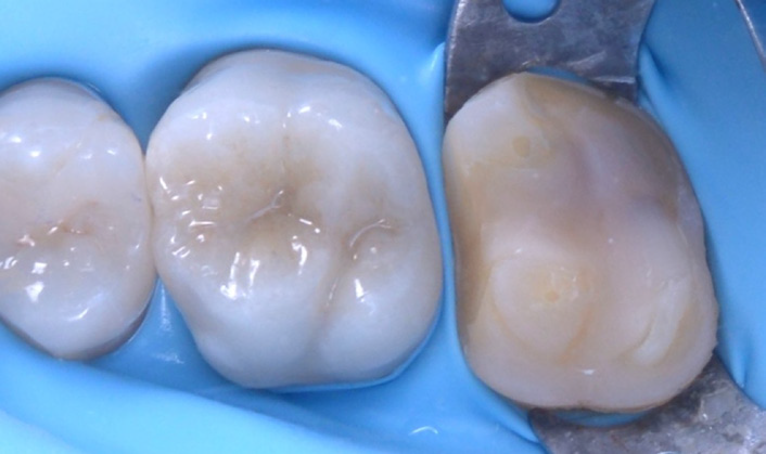 Close-up of three molar teeth with a dental rubber dam and metal clamp on the rightmost tooth