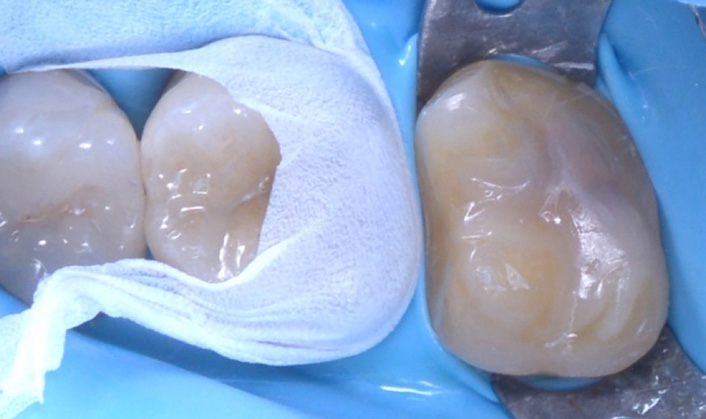 Close-up of two molar teeth with a dental dam and a white cloth between them