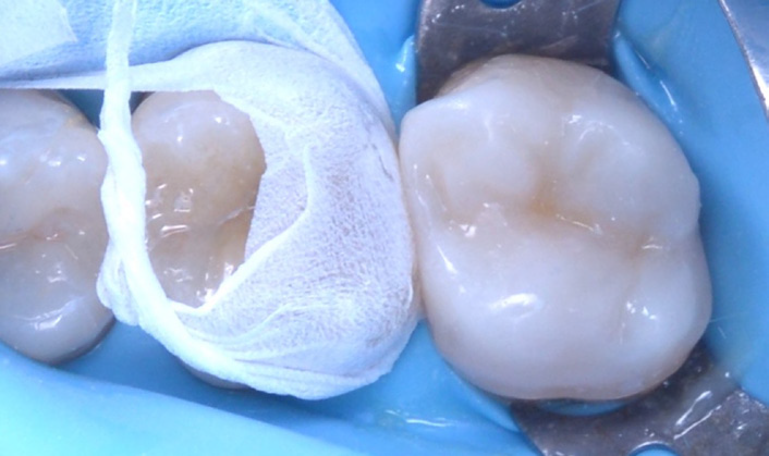 Close-up of two molar teeth with a dental dam and floss around one tooth