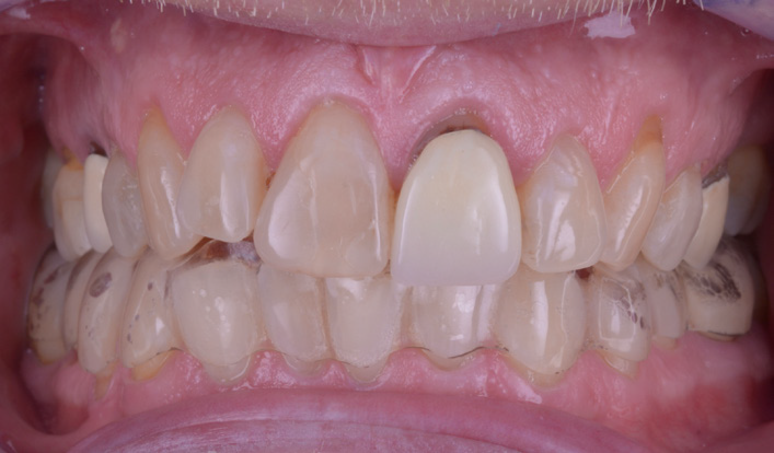Close-up of upper and lower teeth showing dental wear, discoloration, and misalignment