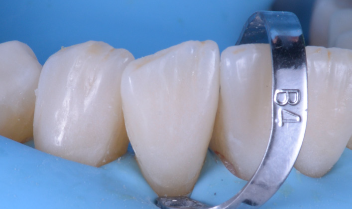 Close-up of dental crowns on molars with a metal dental clamp labeled 'B4' around one tooth