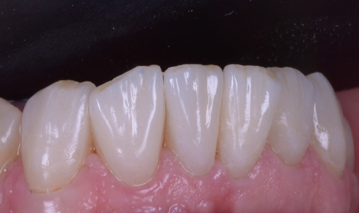 Close-up of upper front teeth with visible dental restorations and natural gum tissue