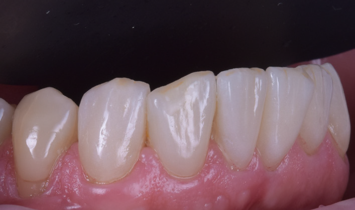 Close-up of lower front teeth and gums showing dental restorations on several teeth